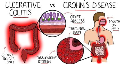 Colita Ulcerativă sau Boala Crohn? Cum Să Faci Diferența și Să Găsești Cel Mai Bun Tratament